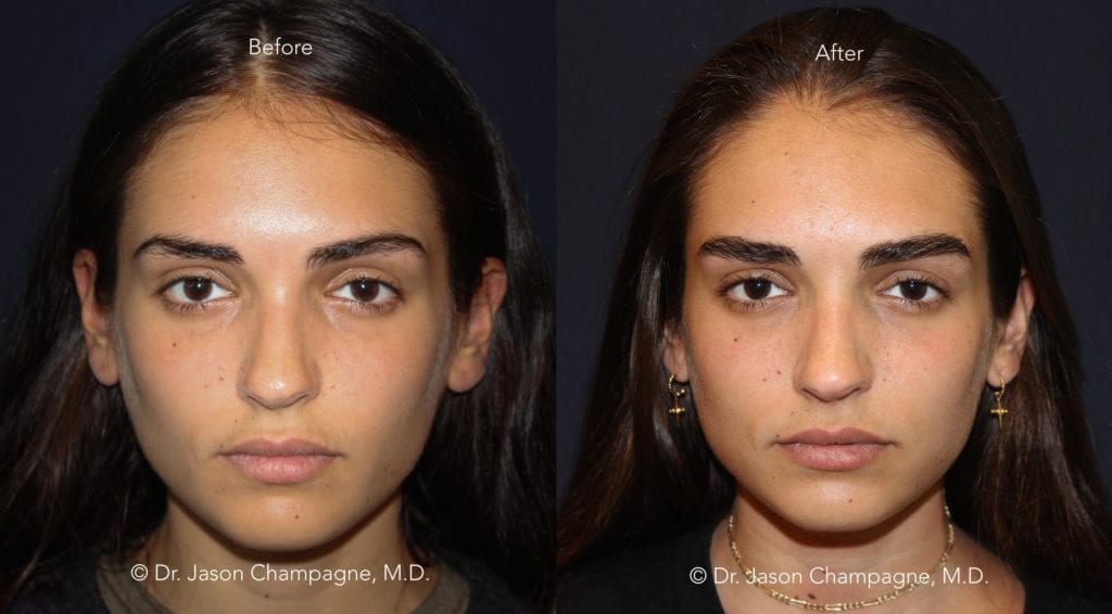 Dr-Jason-Champagne-Eyebrow-Hair-Transplant-Before-and-After