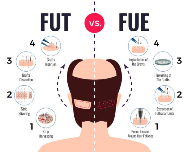 fut-vs-fue
