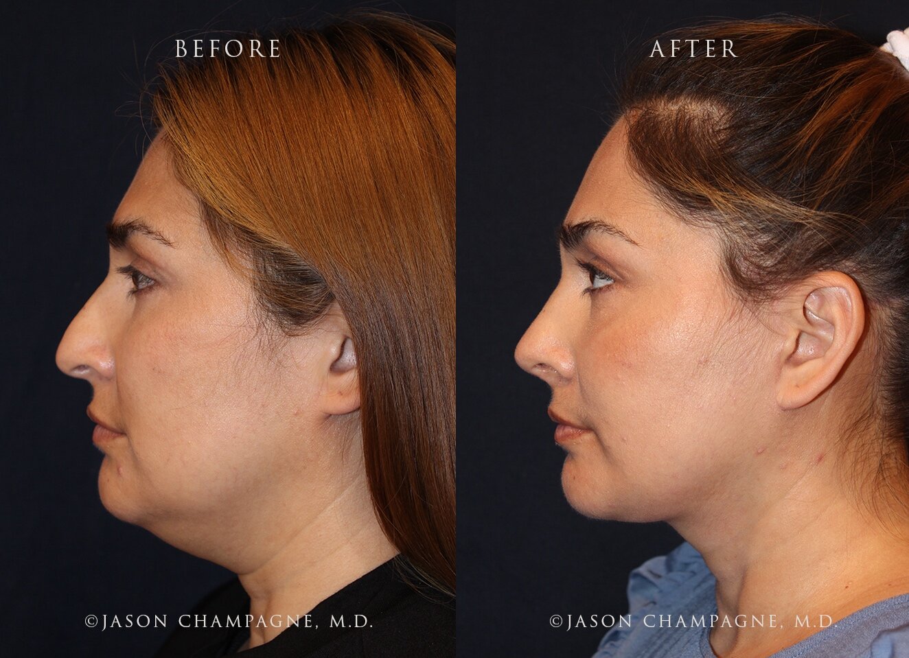 Unlock Your Self-Confidence: The Benefits of Revision Rhinoplasty 1 JasonChampagneFacelift Necklift RhinoplastyBeforeandAfterSide
