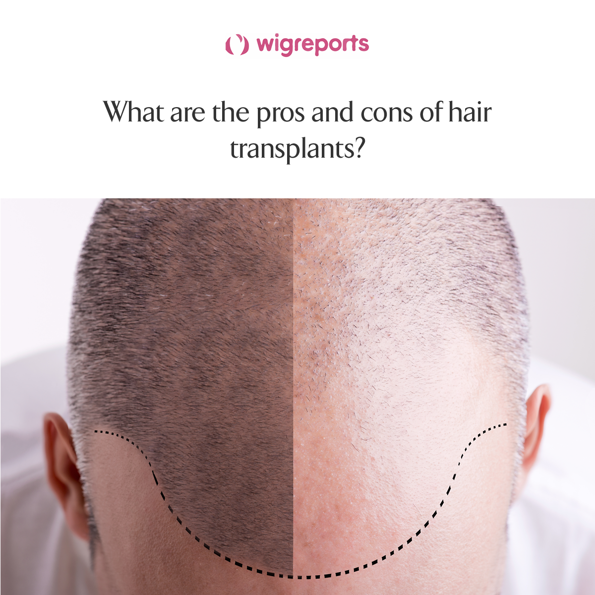 WIG REPORT | Dr. Champagne Answers Your Commonly Asked Plastic Surgery Questions.
