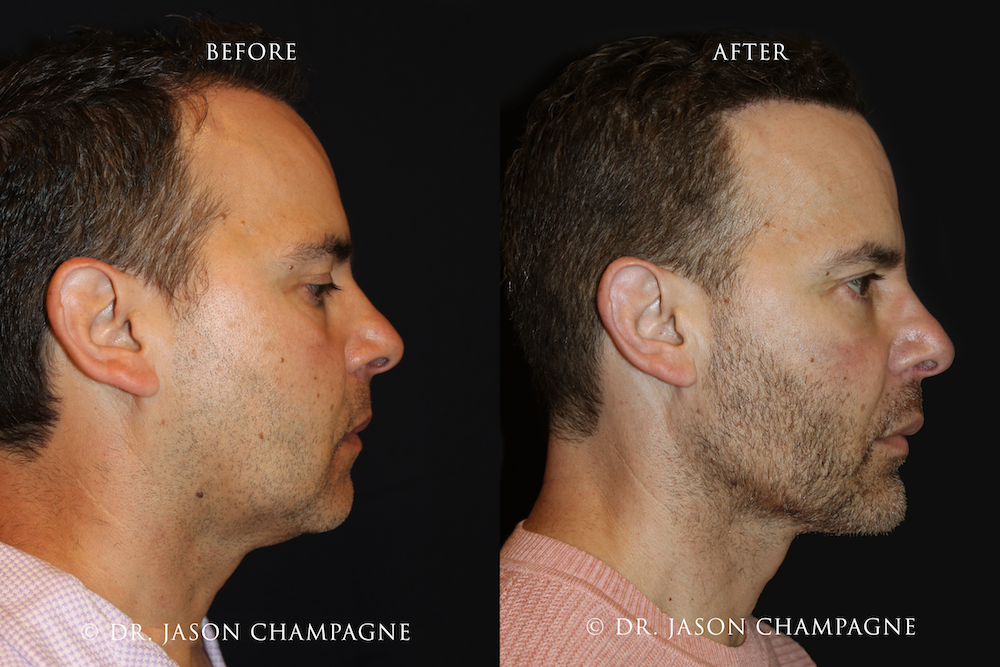 Custom Jaw Implant: Improve Your Lower Facial Contour and Profile 1 1 Custom Chin and Jaw Before and After Profile