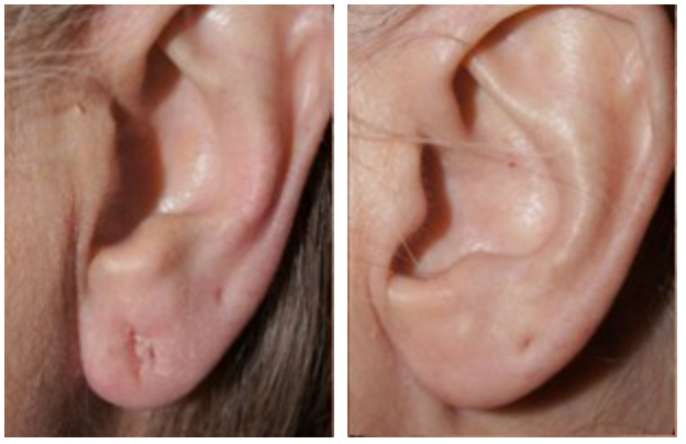 Don't Forget Your Ears: Earlobe Reconstruction and Otoplasty (Ear Reshaping) 2 1 Dr Jason Champagne Earlobe Reconstruction Before and After