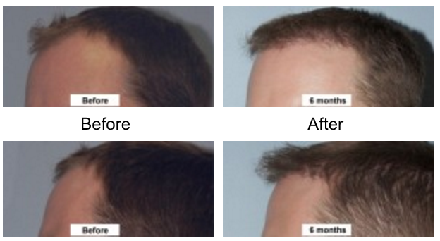 The Intricacies of Hair Restoration 2 1 Dr Jason Champagne Hair Transplantation Before and After