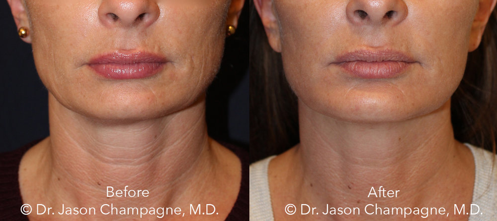 Dr Jason Champagne-mini facelift necklift-chin implant CO2laser-skin resurfacing Before and After Dr Jason Champagne-mini facelift necklift-chin implant CO2laser-skin resurfacing Before and After