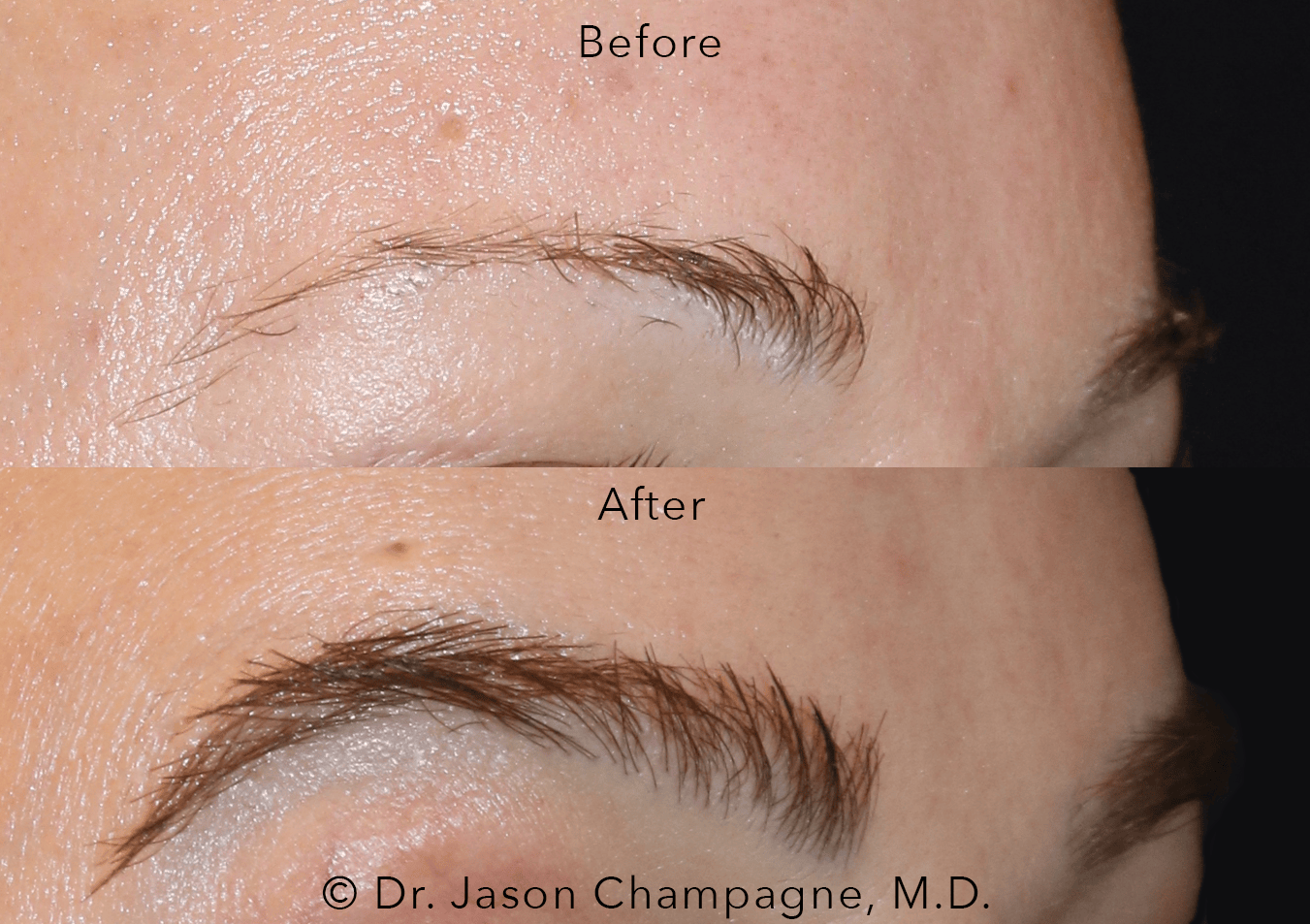 Eyebrow Hair Transplantation: Get Superior and More Natural-Looking Results than Microblading 1 6 Dr Jason Champagne Female Eyebrow Hair Transplant Before and After