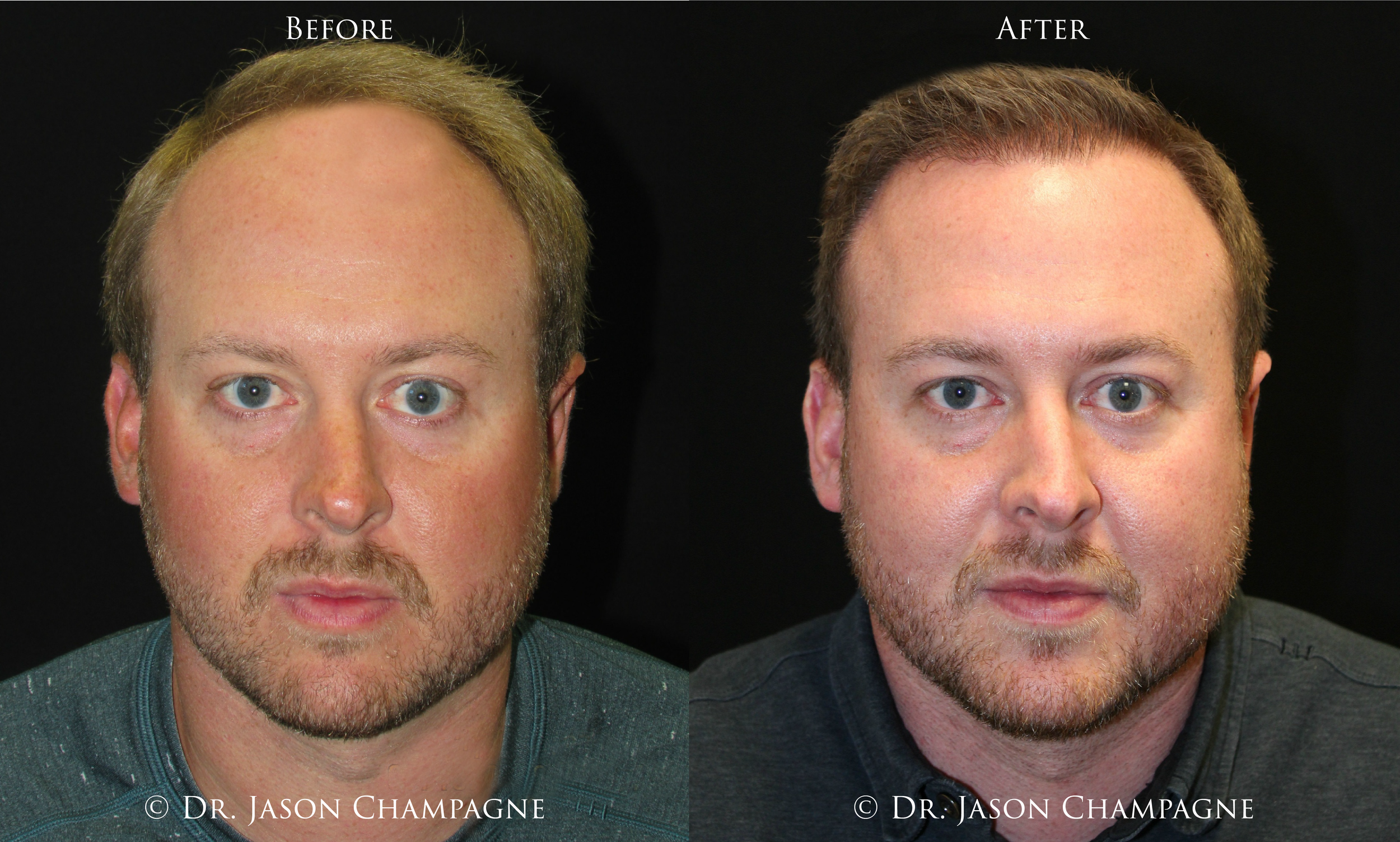Still Dealing with Hair Loss? 1 7 Dr Jason Champagne Hair Transplant Before and After1.22.19