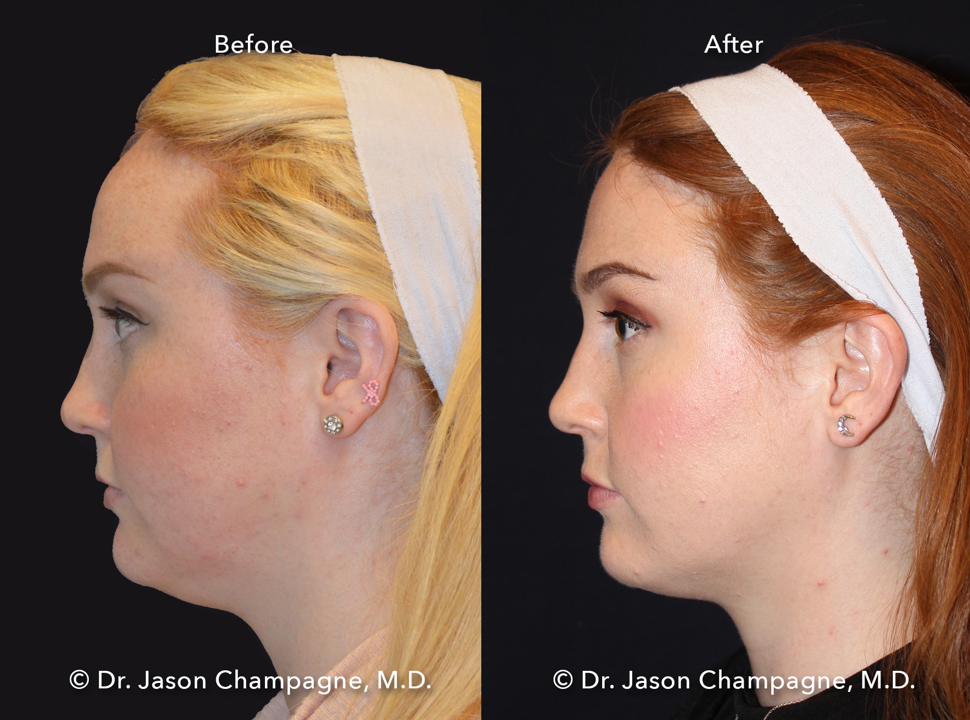 7 Dr Jason Champagne Hairline Lowering Before and After Left Profile