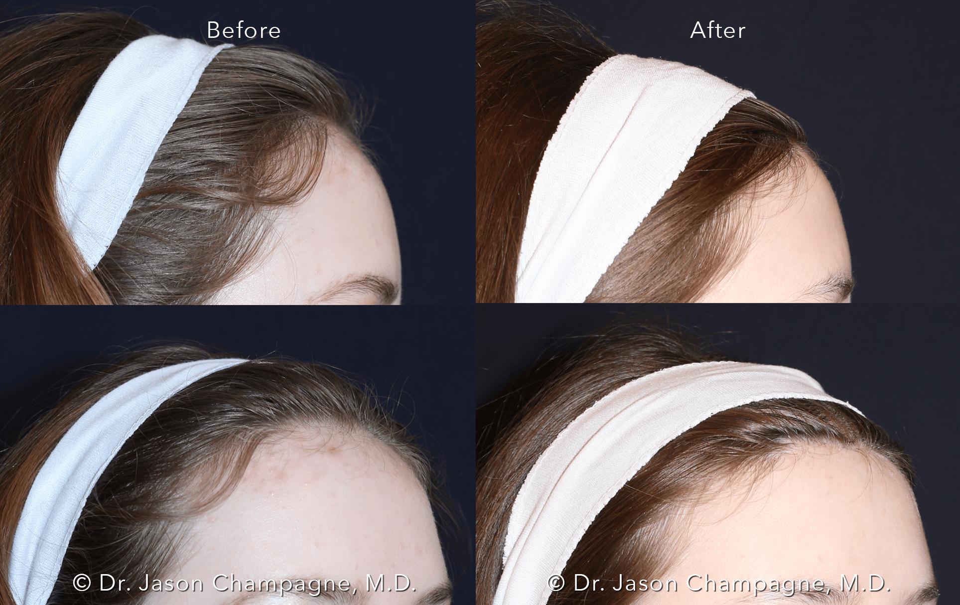 7 Dr Jason Champagne Hairline Lowering Before and After
