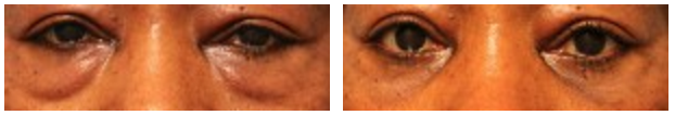 Brighten Your Eyes with a Blepharoplasty 2 Case3452LowerBlepharoplasty