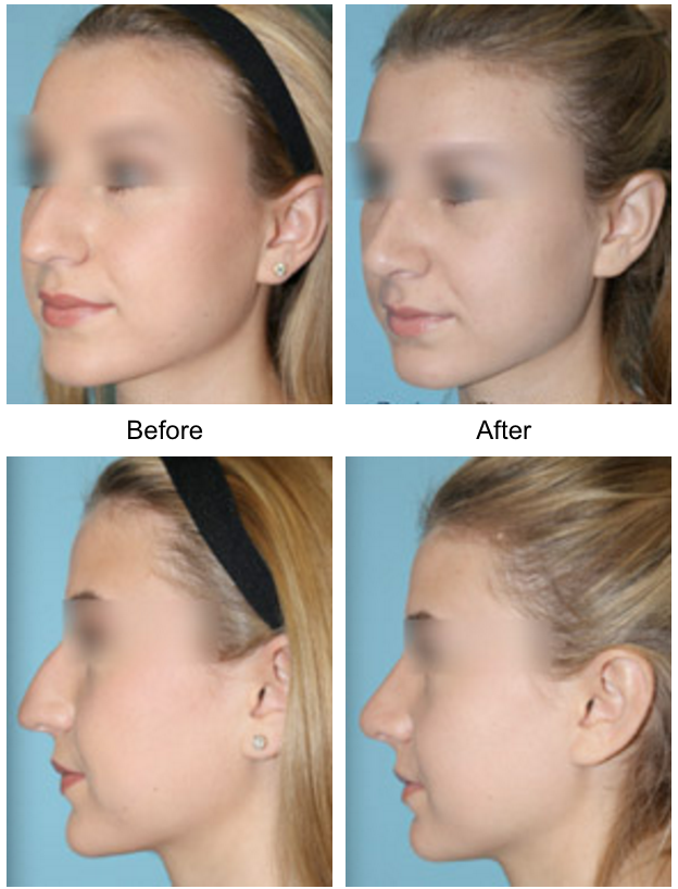Common Insecurities: Your Nose 1 Dr Jason Champagne Beverly Hills Plastic Surgery Rhinoplasty Before and After