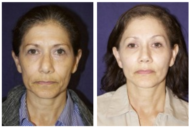 Rejuvenating Your Upper Face 4 Dr Jason Champagne Blepharoplasty Procedure Before and After