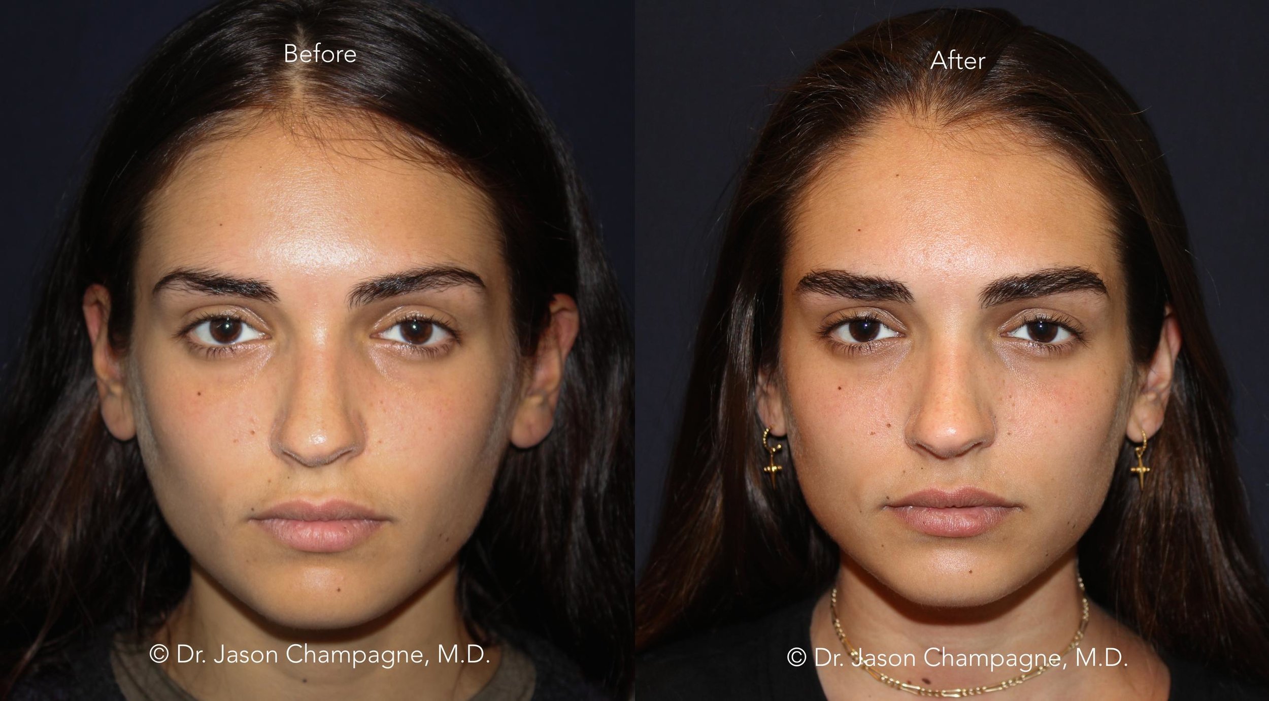 Rejuvenating Your Upper Face 3 Dr Jason Champagne Eyebrow Hair Transplant Before and After