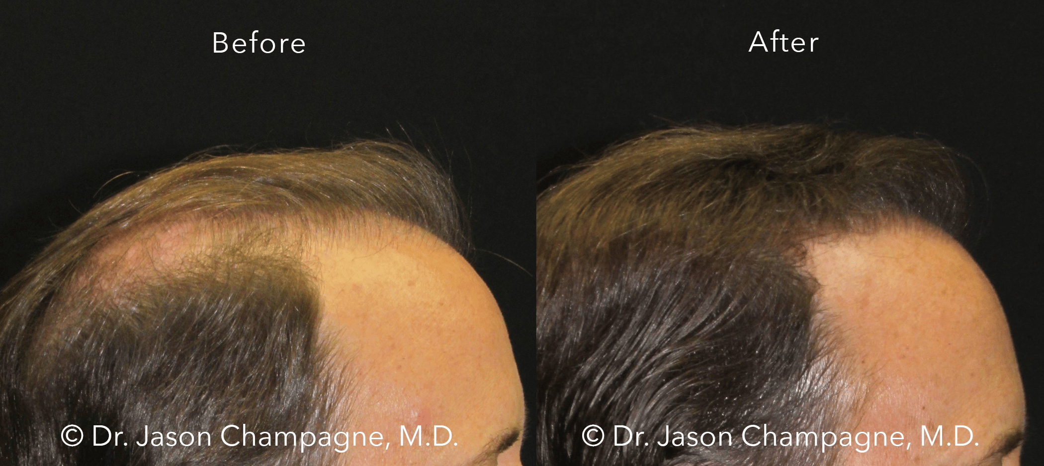 Dealing With Hair Loss Or A High Hairline? These Two Procedures Can Help You Out 2 Dr Jason Champagne Hair Transplant Before and After Profile 7 26