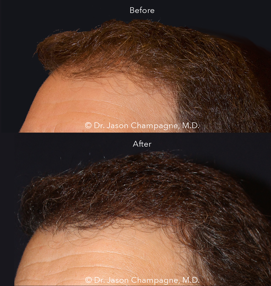 Dr Jason Champagne Hair Transplant Before and After