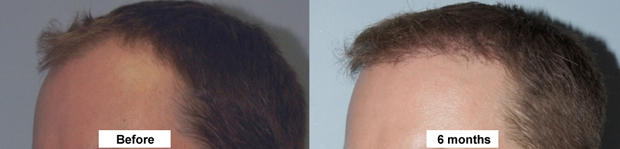 Rejuvenating Your Upper Face 2 Dr Jason Champagne Hair Transplant Facial Plastic Surgery Beverly Hills Before and After