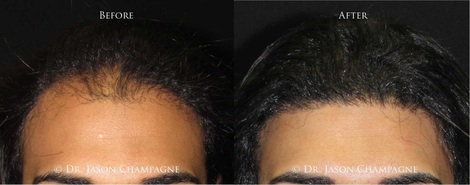 World Class Hair Restoration Beverly Hills 1 Dr Jason Champagne Hair Transplantation Before and After 3 11 191 01 01