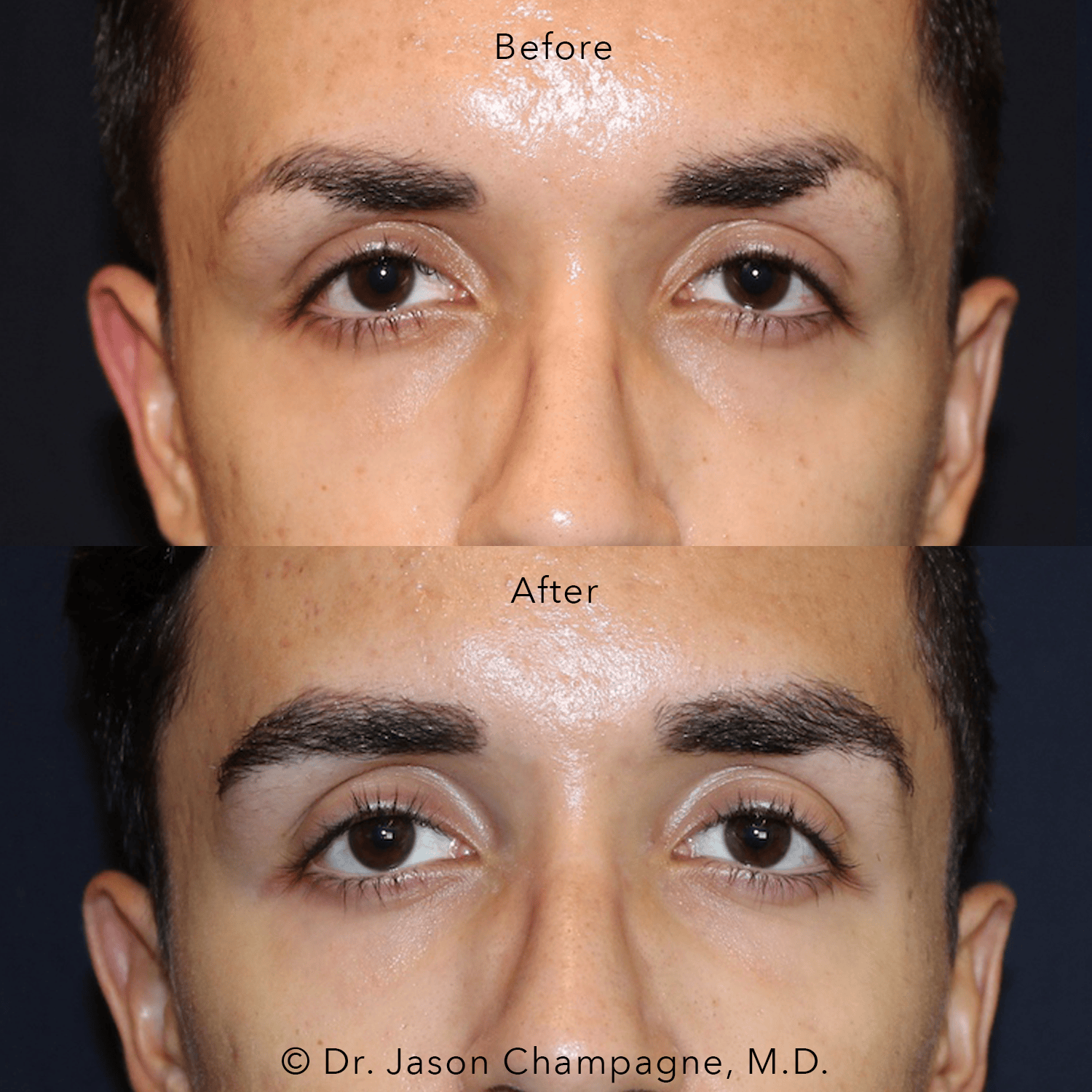 Male Eyebrow Hair Transplant 1 Dr Jason Champagne Male Eyebrow Hair Transplant Before and After