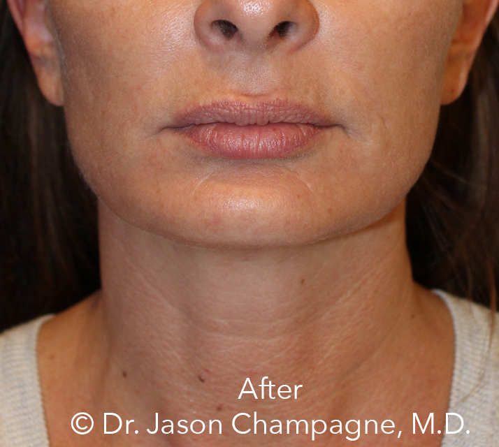 Dr-Jason-Champagne-mini facelift-necklift-chin-implant-CO2 laser-skin-resurfacing-After.jpg