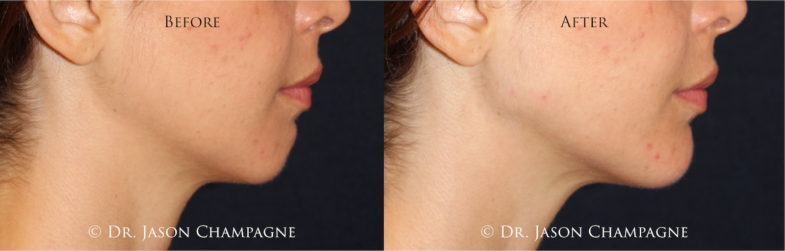Fill Your Holidays With Customized Facial Fillers 1 Dr.JasonChampagneCustomFacialFillerBeforeandAfterChinContouring