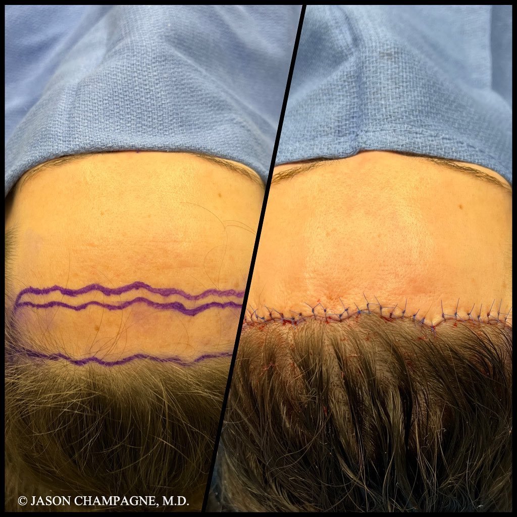 Hairline Lowering and Forehead Reduction Surgery - before and after