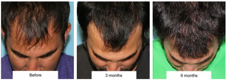 Hair Transplantation 1 HairTransplantBeverlyHillsFacialPlasticSurgery
