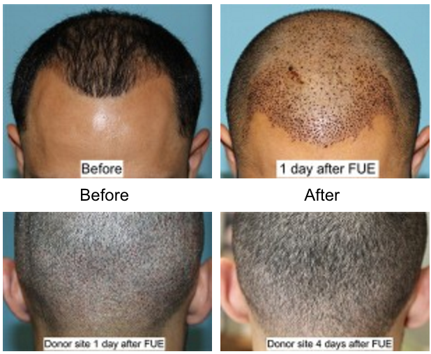 Hair Transplantation 2 HairTransplantBeverlyHillsFacialPlasticSurgery2