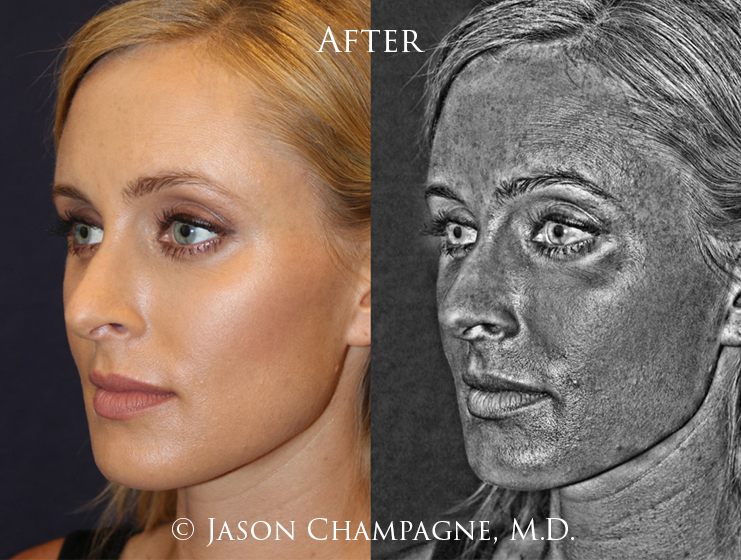 Keep it Bright, Keep it Tight 2 Jason Champagne IPL After