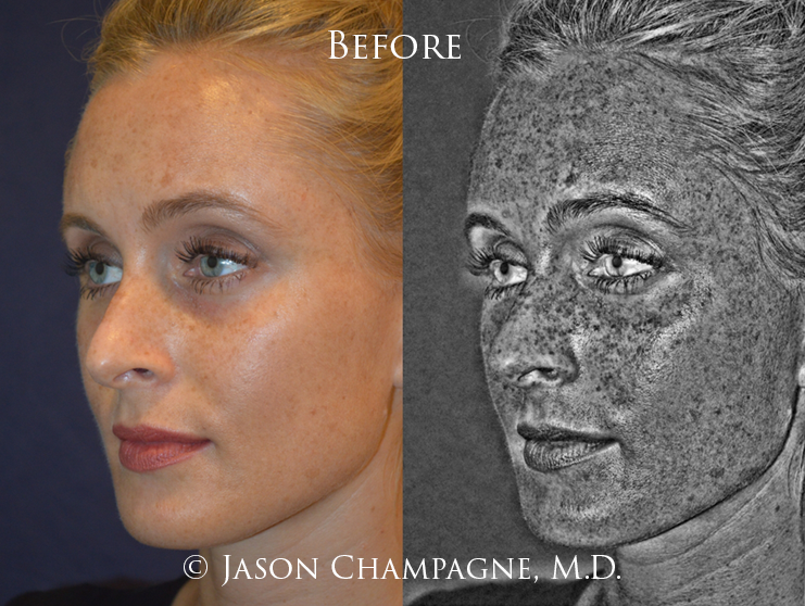 Keep it Bright, Keep it Tight 1 Jason Champagne IPL Before