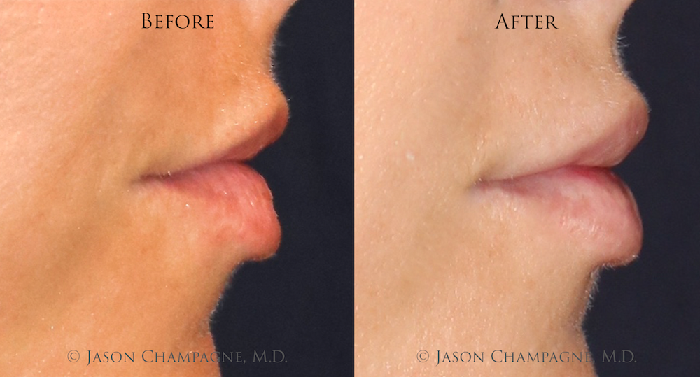 Make It All About The Lips: Lip Lifts With Dr. Champagne 1 Jason Champagne Lip Augmentation Before and After