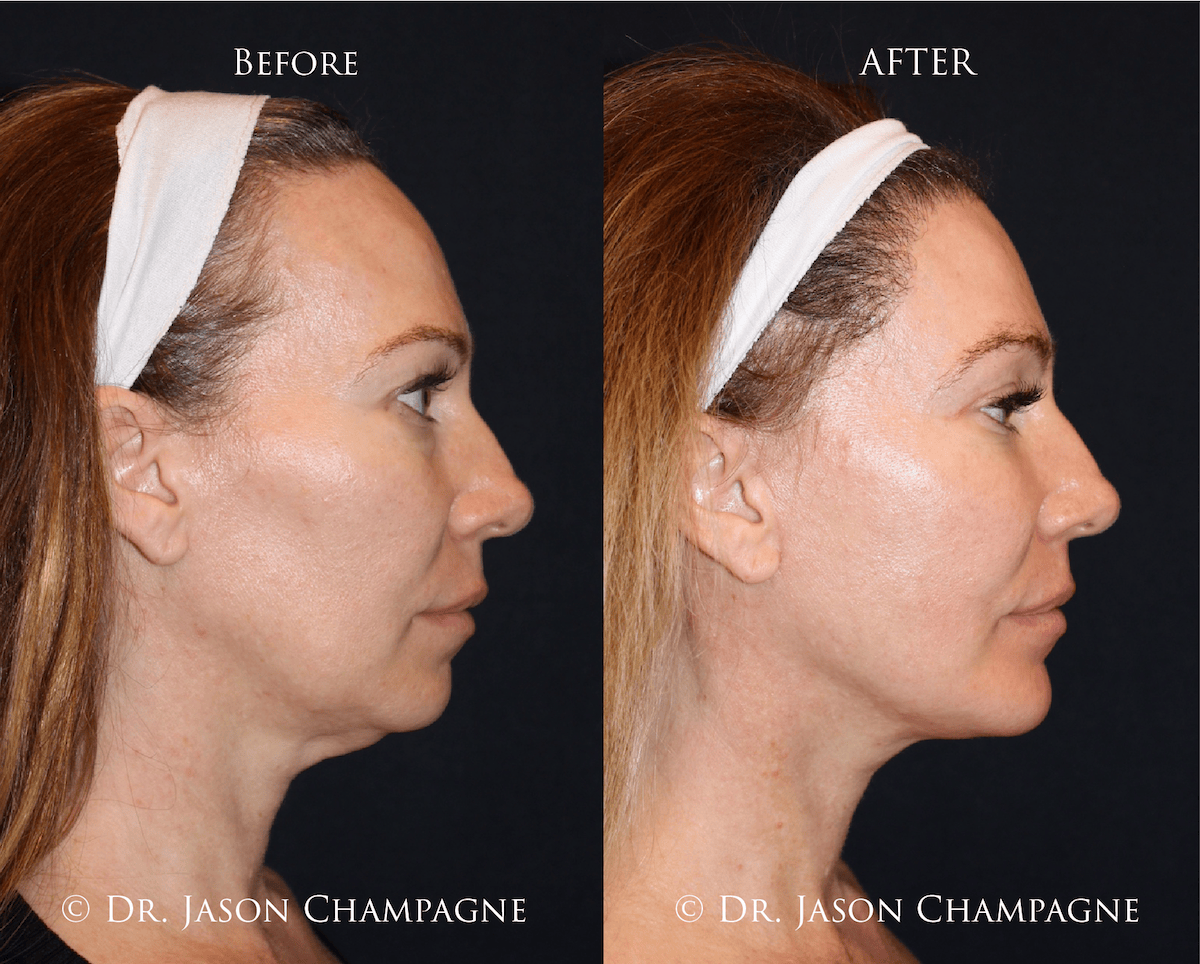 Combined facial rejuvenation before and after, profile view: facelift, neck lift, eyelid surgery, CO₂ resurfacing, fat transfer, hairline transplantation and chin implant