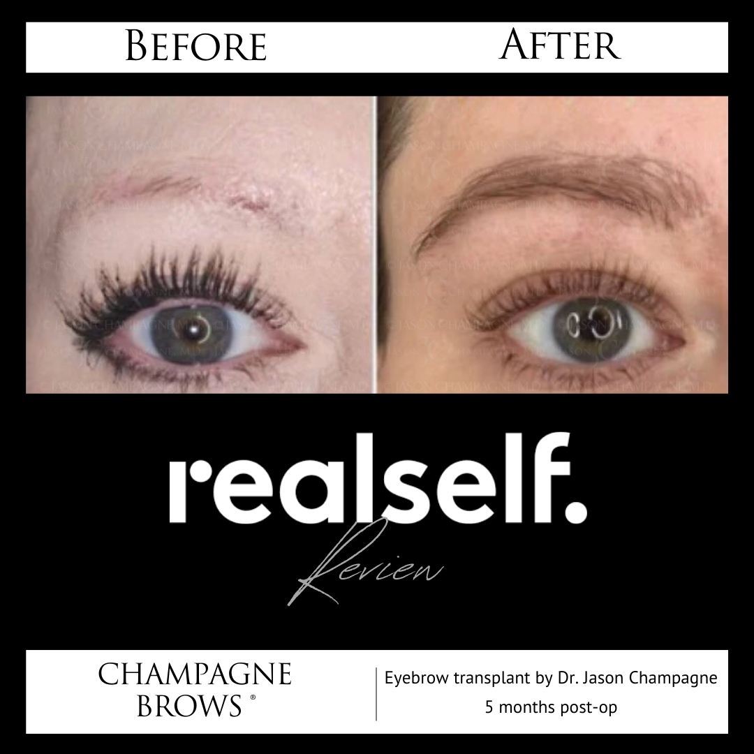 Dr. Champagne before & after