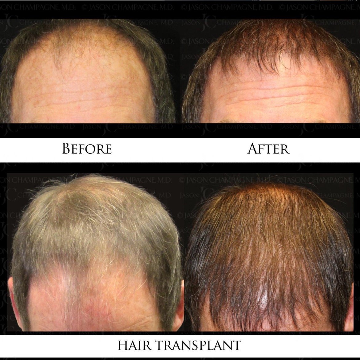 HairTransplant_Before&After_DrChampagne