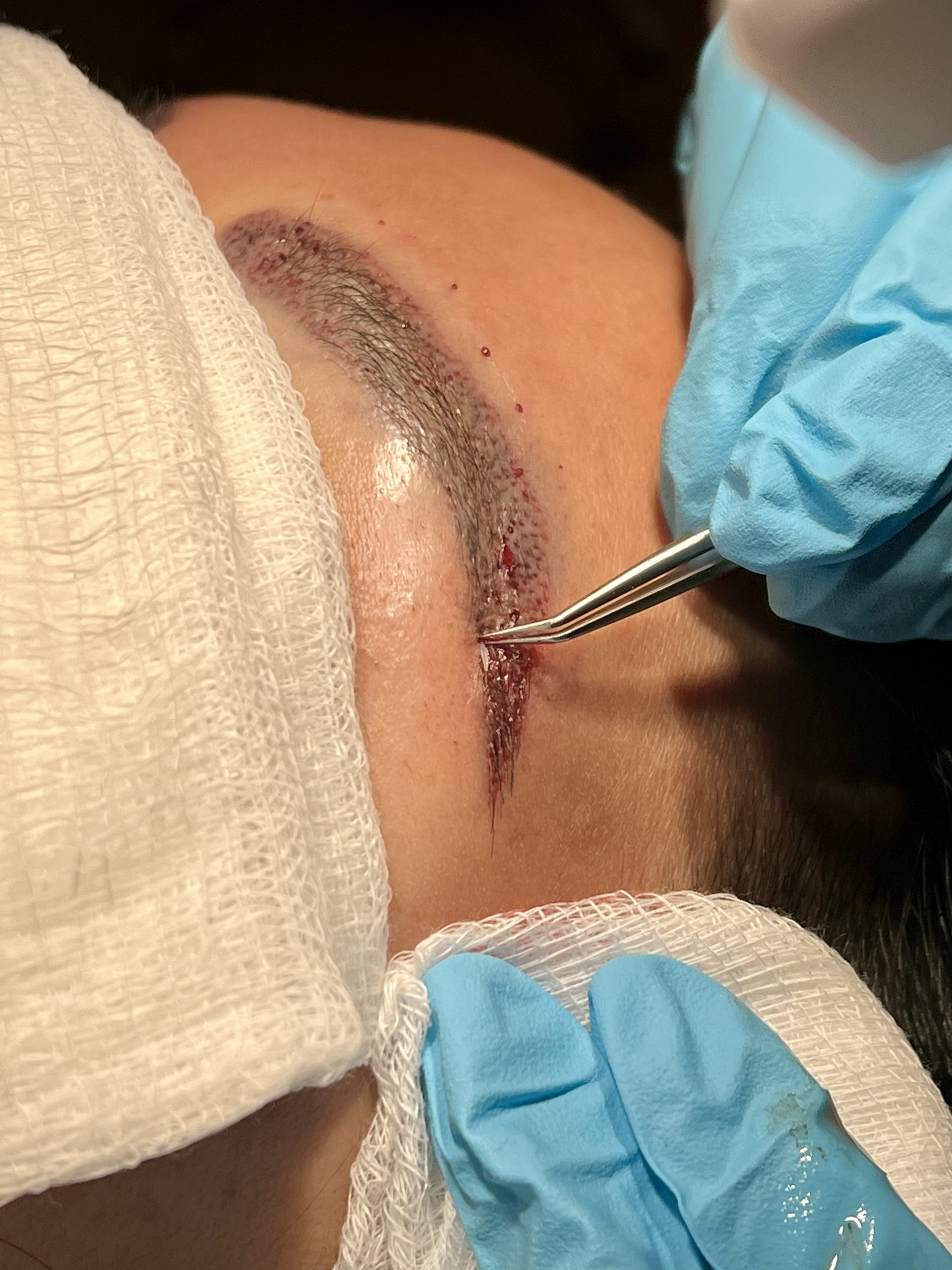 Champage Brows Procedure