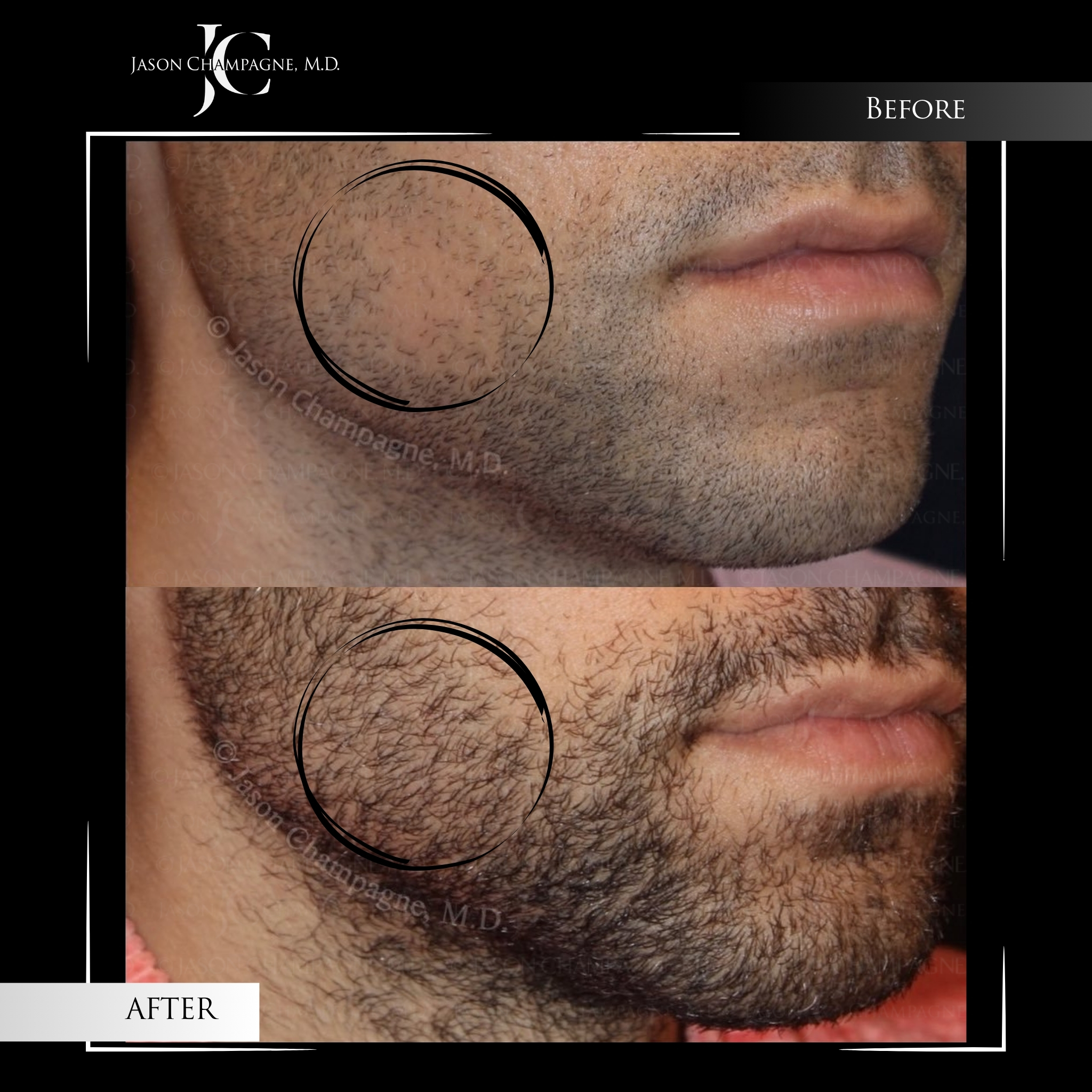 Champagne Beard Transplant by Dr. Jason Champagne | Beverly Hills
