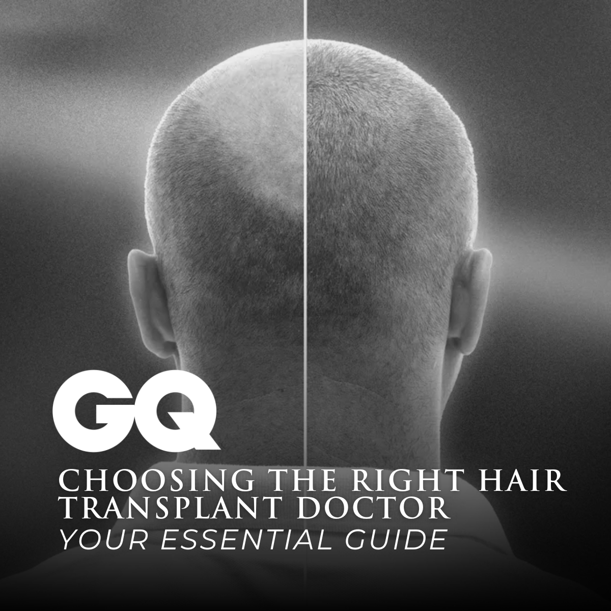 GQ feature on Hair Transplants Dr. Jason Champagne