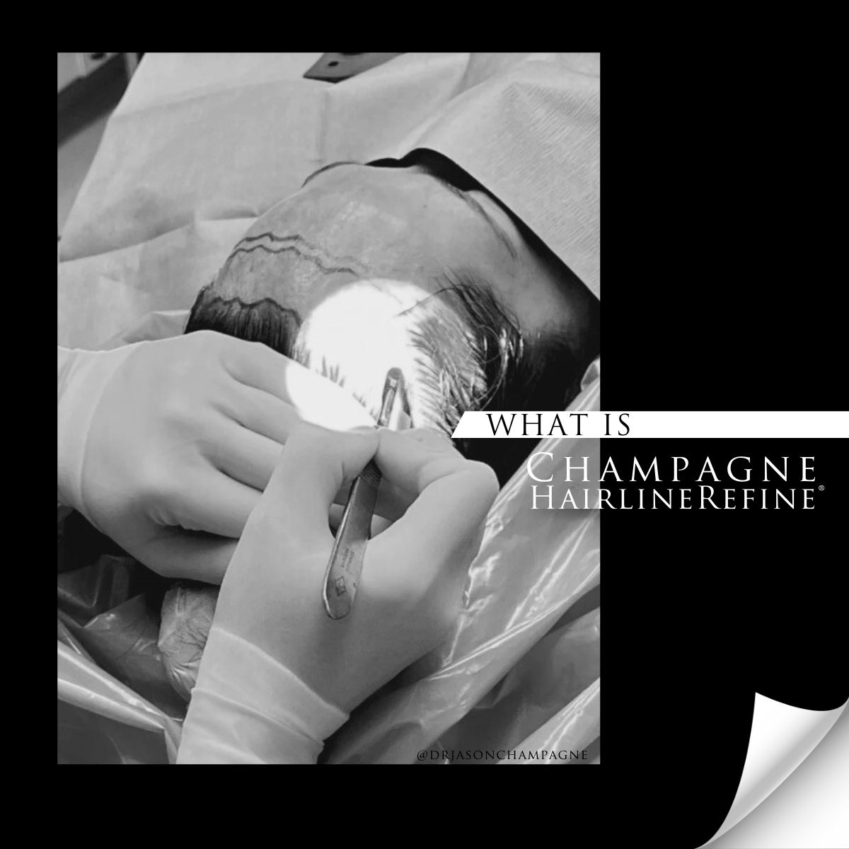 Hairline Lowering Surgery - Champagne HairlineRefine technique