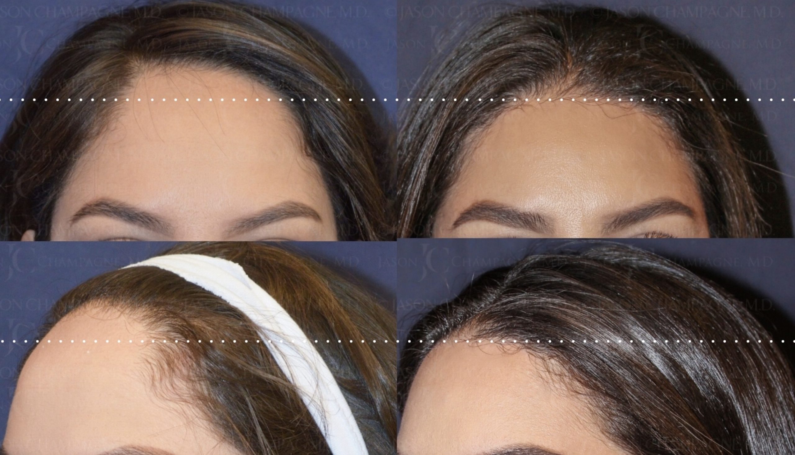 hairline lowering dr jason champagne