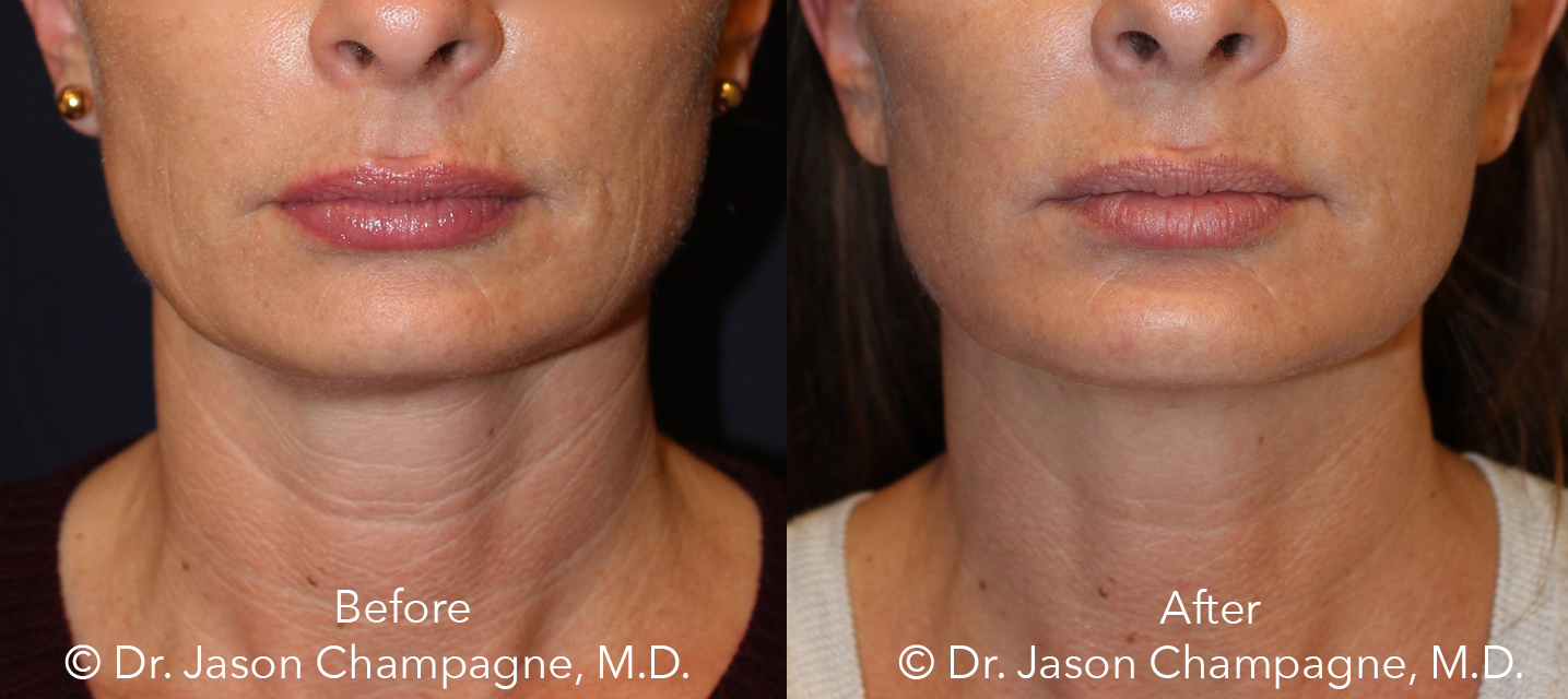 Dr Jason Champagne mini facelift necklift chin implant CO2laser skin resurfacing Before and After Front