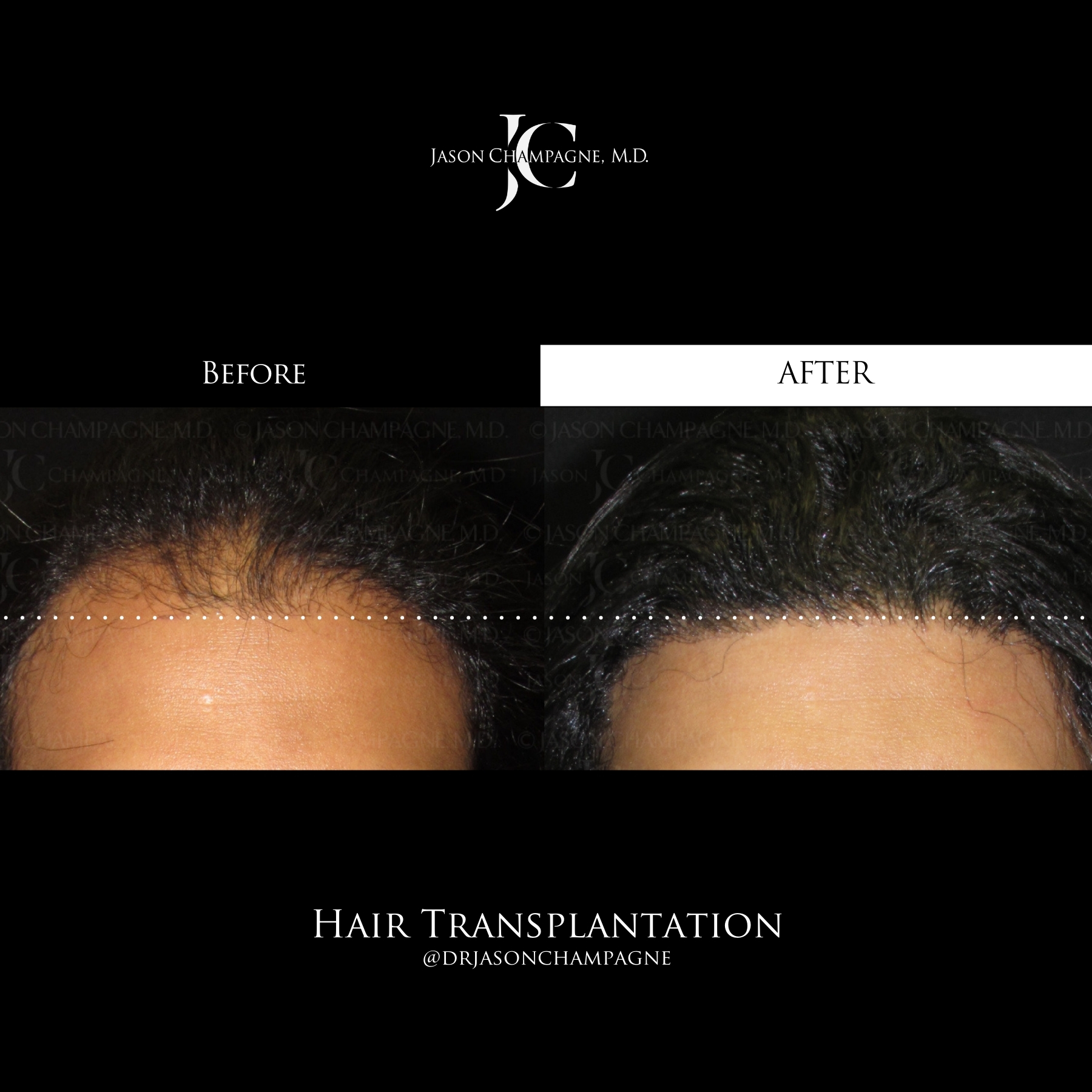 Hair Transplantation Before & After Dr. Champagne