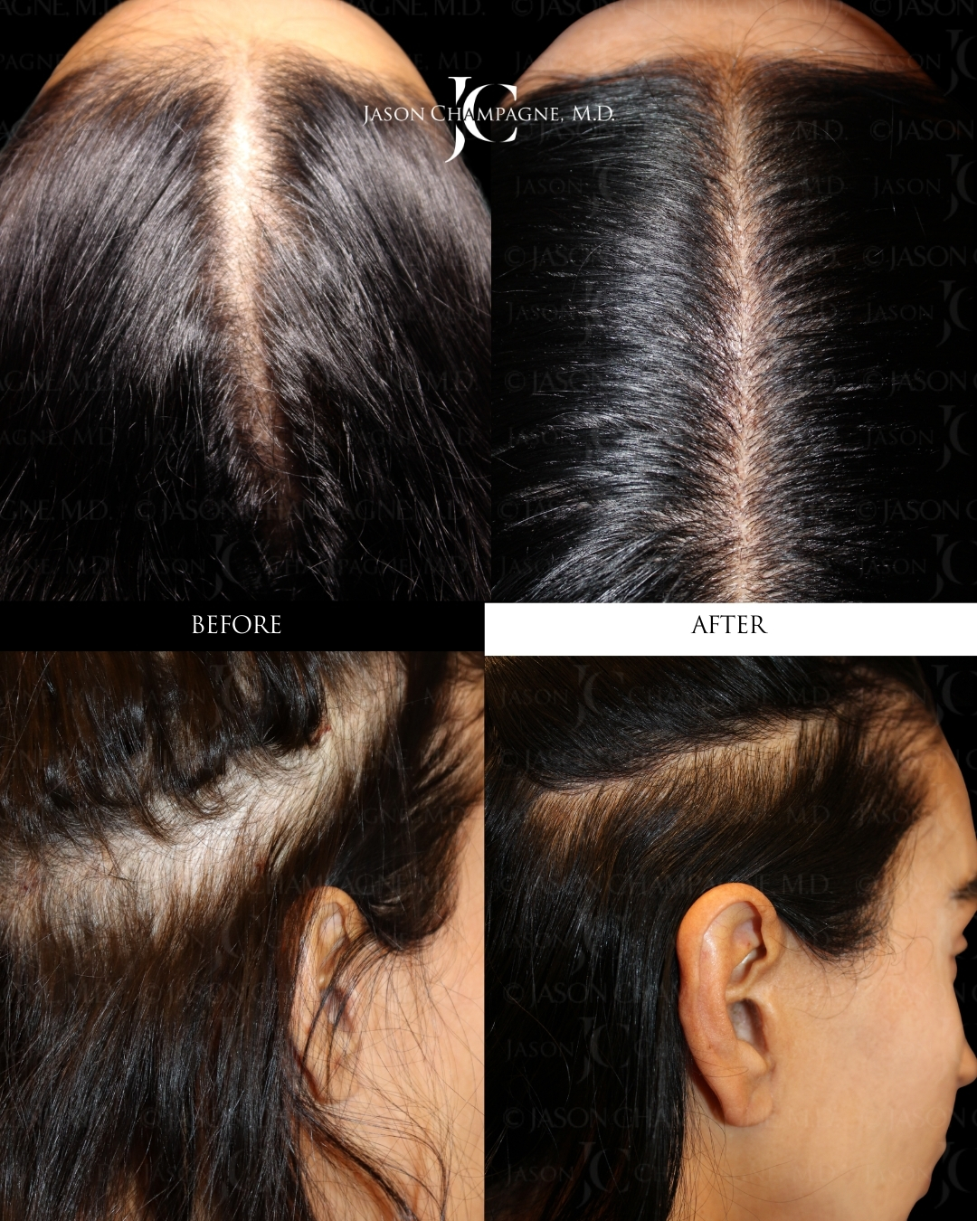 Regenerative Hair Therapy by Dr. Champagne Beverly Hills