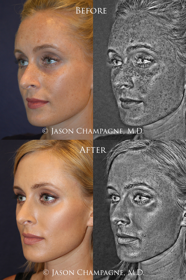 4 Jason Champagne IPL Before and After