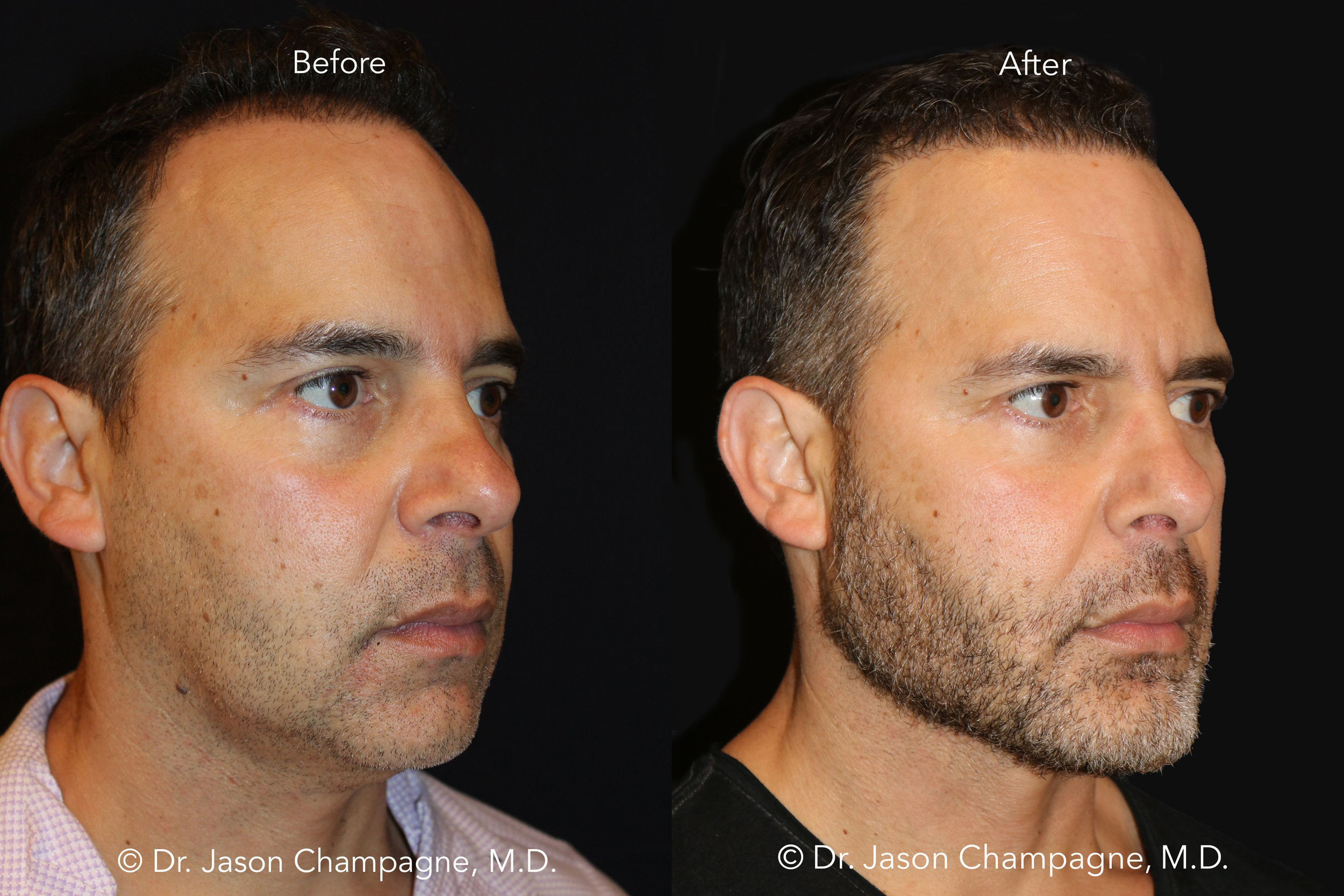 Dr Jason Champagne Custom Chin and Jaw Hair Transplantation Before and After 3 4