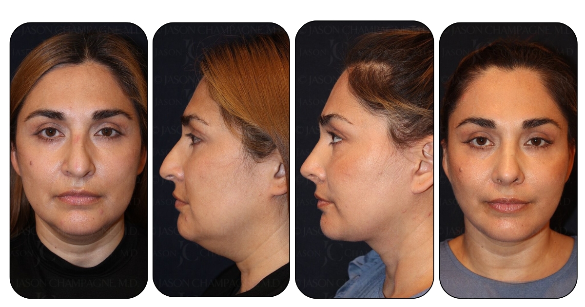 Facelift_before_and_after_Dr-Champagne