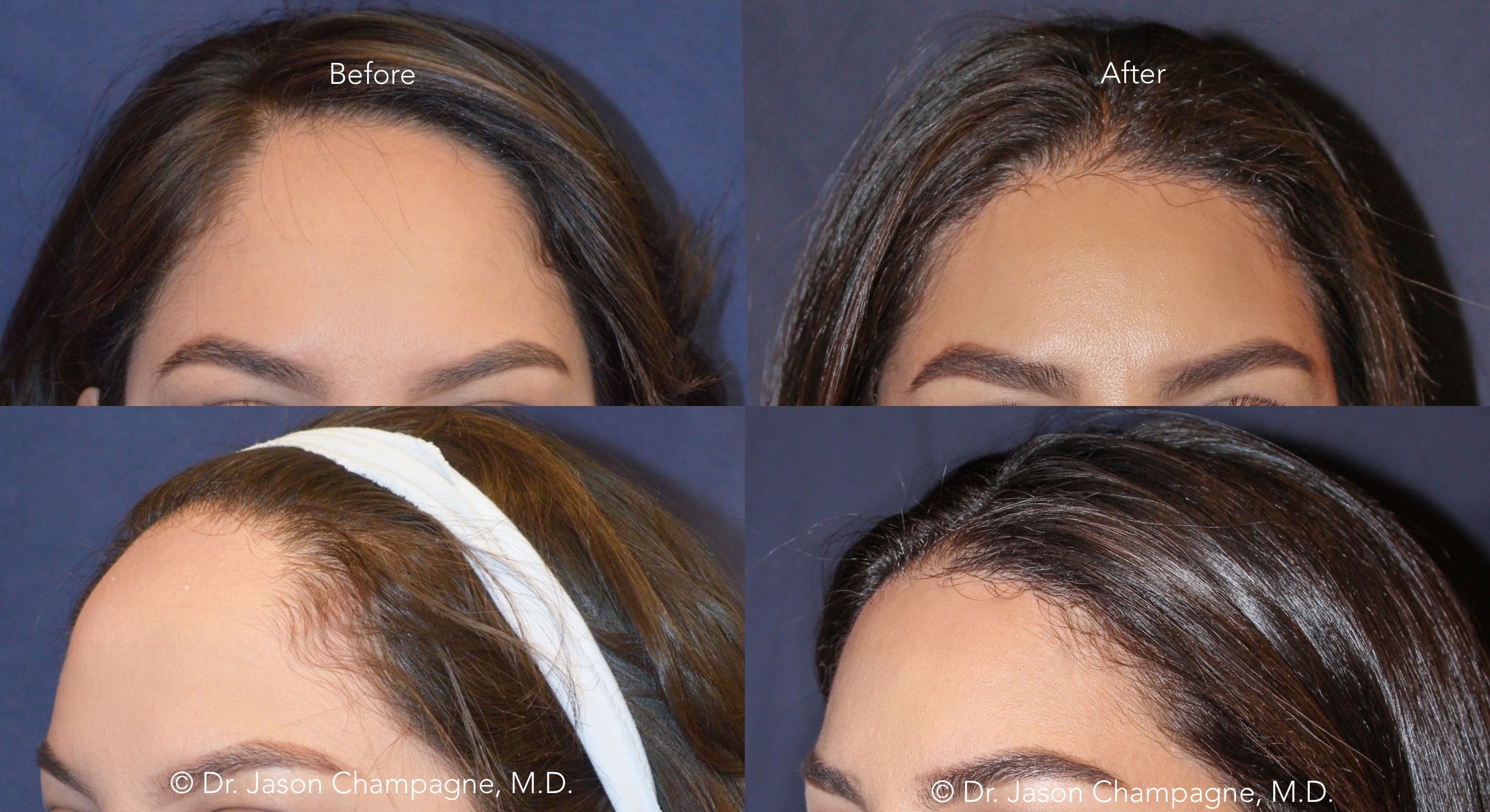 Dr Jason Champagne Hairline Lowering Before and After 3