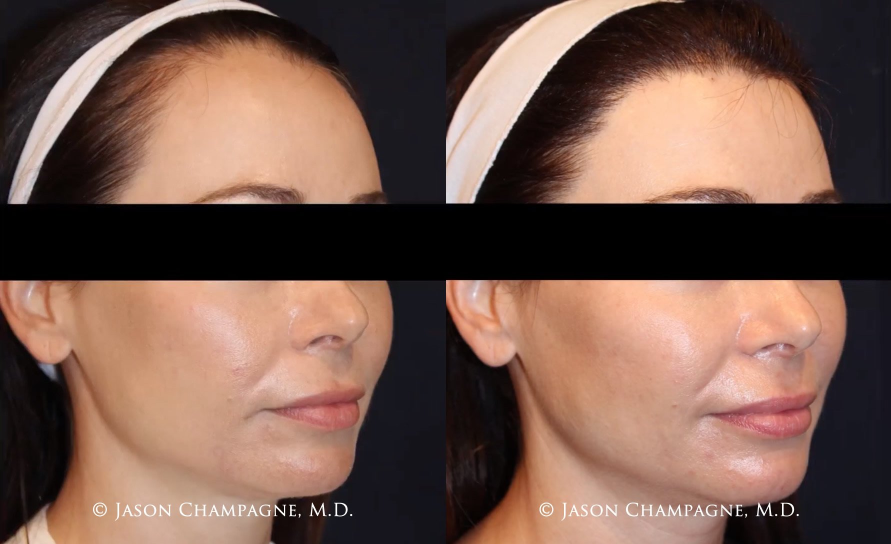 Dr.JasonChampagnehairline lowering2 1